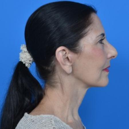 After image 3 Case #88061 - Facelift and Neck Lift