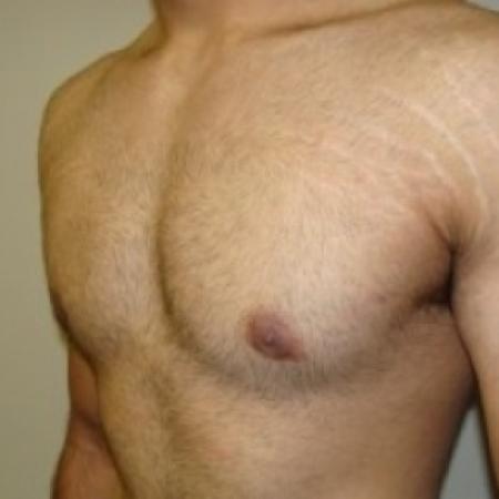 After image 2 Case #79046 - Gynecomastia
