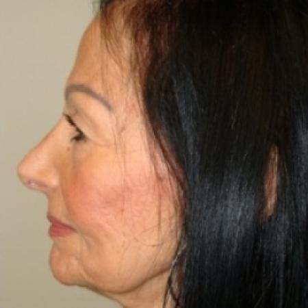 After image 5 Case #79546 - Rhinoplasty