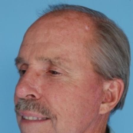 After image 2 Case #79681 - Facelift