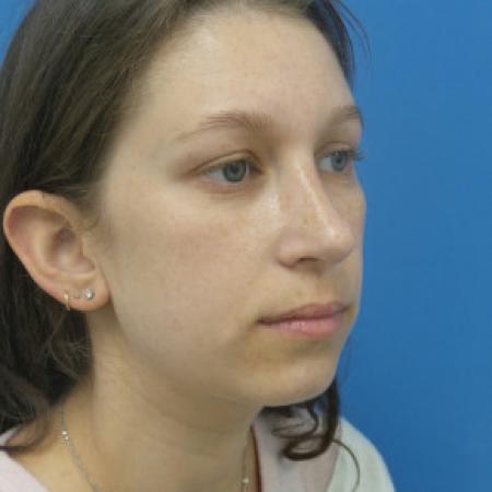 After image 2 Case #88391 - 25 year old  -  Rhinoplasty/Septoplasty/Partial Turbinectomy  -  7 months post-op