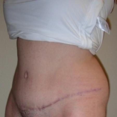 After image 2 Case #79766 - Tummy Tuck & Lipo of Love Handles
