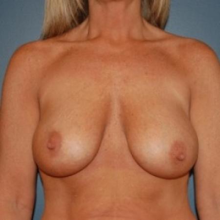 After image 1 Case #81256 - Bilateral breast augmentation with saline filled implants 