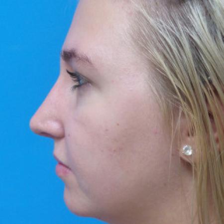 After image 3 Case #88316 - 19 year old  -  Open Rhinoplasty  -  6 months post-op