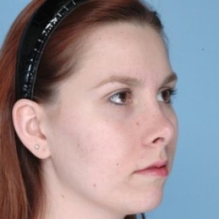 After image 2 Case #79671 - Rhinoplasty 