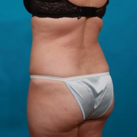 After image 4 Case #85721 - Abdominoplasty with Flank Liposuction
