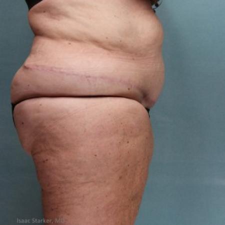 After image 2 Case #86821 - After Weight Loss Body Contouring Panniculectomy