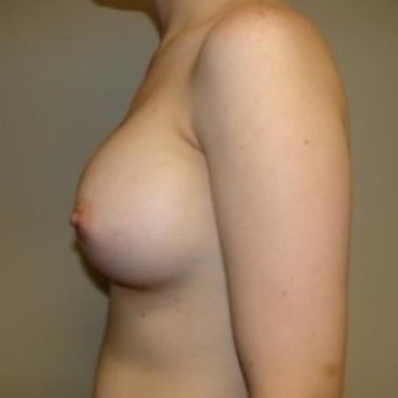 After image 5 Case #79721 - Breast Augmentation