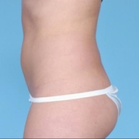 After image 3 Case #79281 - Non-Surgical