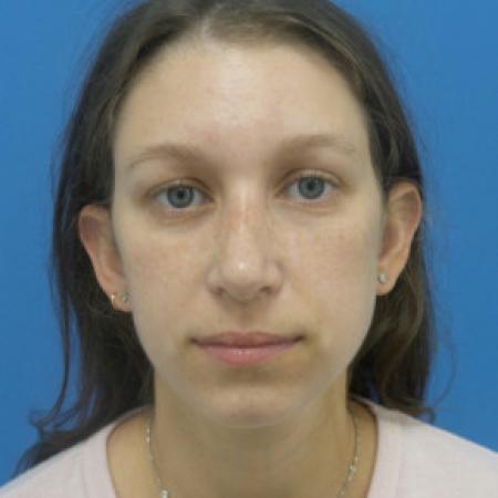 After image 1 Case #88391 - 25 year old  -  Rhinoplasty/Septoplasty/Partial Turbinectomy  -  7 months post-op