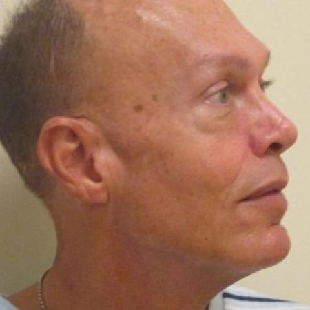 After image 2 Case #82721 - Facial Fat transfer - Male