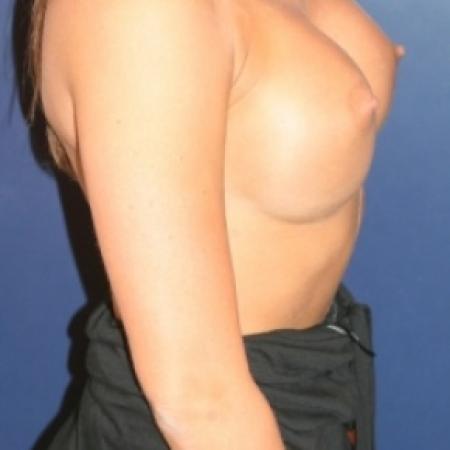 After image 3 Case #79751 - Proportional Breast Augmentation