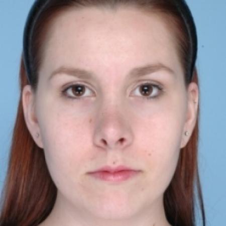 After image 1 Case #79671 - Rhinoplasty 