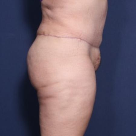 After image 2 Case #83571 - 36 Years Old Female 