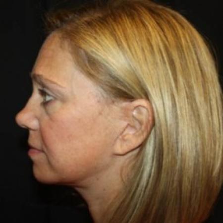 After image 3 Case #83761 - Facelift - 49 year old female.
