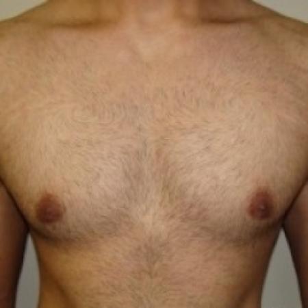 After image 1 Case #79046 - Gynecomastia