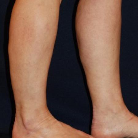 After image 2 Case #87641 - Lower Leg Liposuction