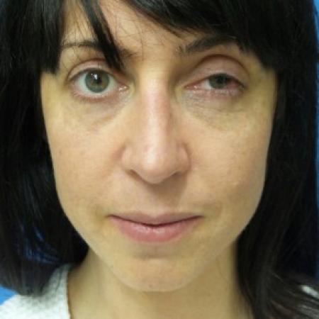 After image 1 Case #86856 - 40 year old woman treated with Nose Surgery/Septoplasty/Turbinectomy