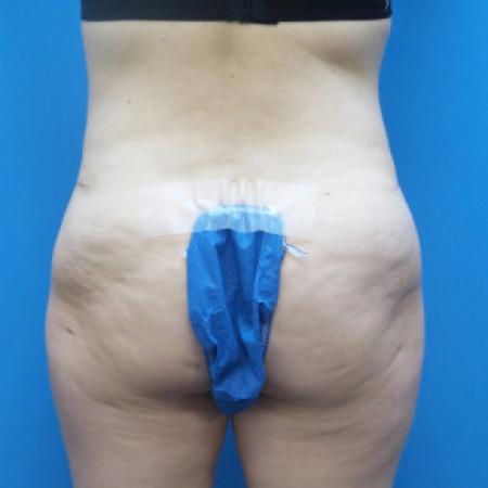 After image 4 Case #88171 - 41 year old  -  Abdominoplasty  -  3 months post-op