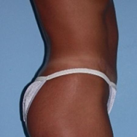 After image 2 Case #79146 - Tummy Tuck