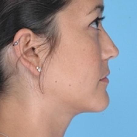 After image 2 Case #79201 - Liposuction