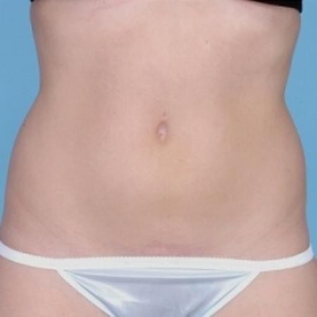 After image 1 Case #79281 - Non-Surgical