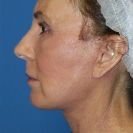 After image 3 Case #86576 - Facelift/Laser Resurfacing to Full Face     1 month post-op