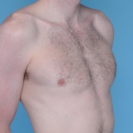 After image 2 Case #82256 - Liposuction