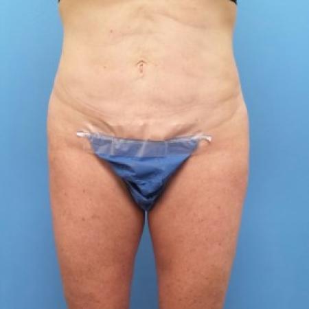 After image 1 Case #87166 - 55 year old  -  Liposuction of abdomen, waist, flanks, mons pubis/SkinTite with J-Plasma RF to the anterior abdomen   -   3 month post-op