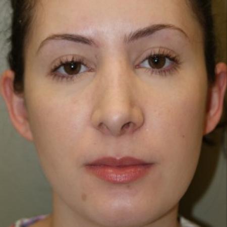 After image 1 Case #81871 - Open Septorhinoplasty