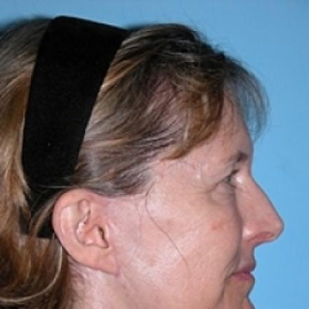 After image 2 Case #79276 - Facelift