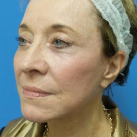 After image 2 Case #87181 - 68 year old  -  Facelift  -  3 months post-op
