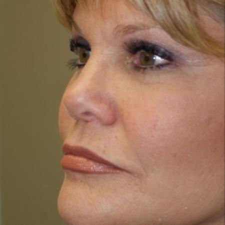 After image 2 Case #81906 - Facelift