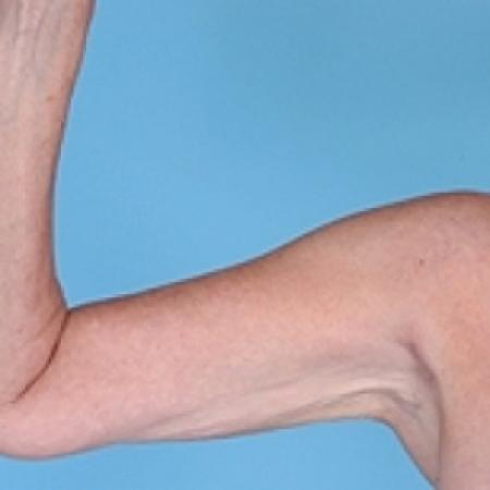 After image 1 Case #79226 - Liposuction