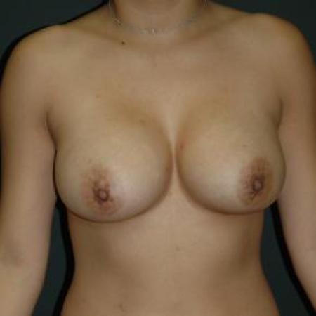 After image 1 Case #80821 - Breast Augmentation