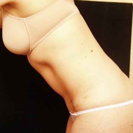 After image 2 Case #81726 - Tummy Tuck
