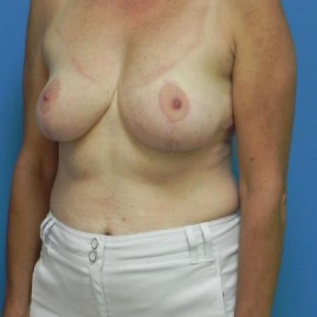 After image 2 Case #81921 - Bilateral Breast Reduction