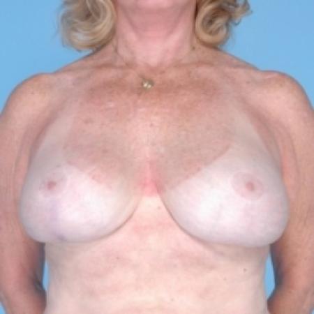 After image 1 Case #79666 - Breast Augmentation 
