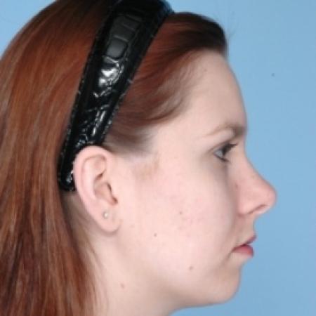 After image 3 Case #79671 - Rhinoplasty 