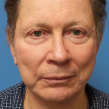 After image 1 Case #86571 - Facelift/Chin Augmentation with Implant     7 months post-op