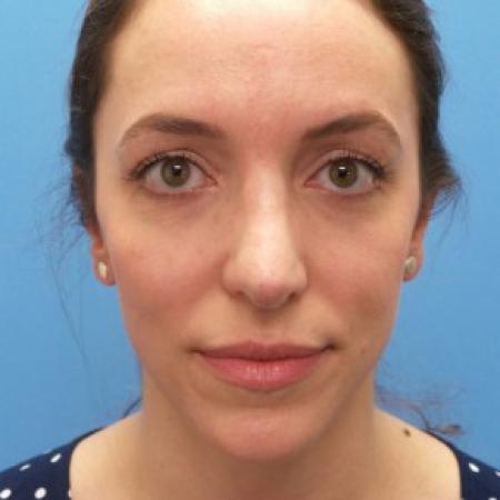 After image 1 Case #87411 - 31 year-old  -  Open Rhinoplasty/Endoscopic Browlift  -  3 months post-op