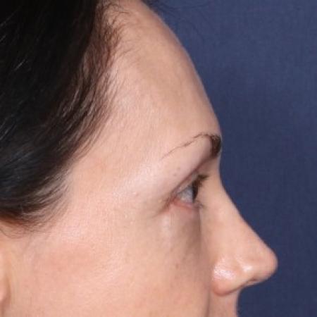 After image 2 Case #85031 - 50 Years old female