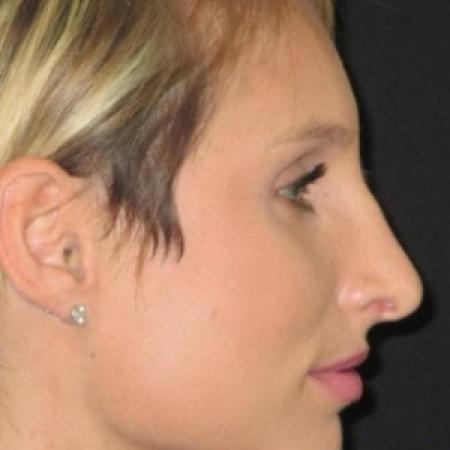 After image 2 Case #82791 - Septorhinoplasty