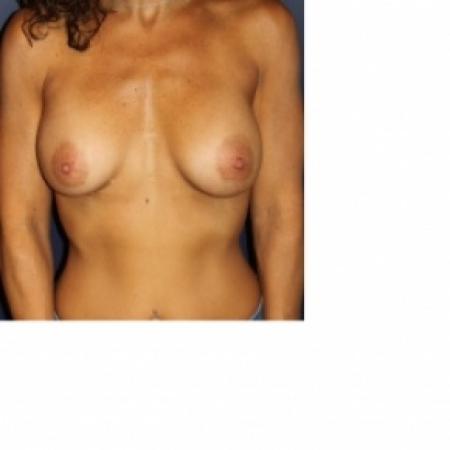 After image 1 Case #80801 - Natural Proportional Breast Augmentation