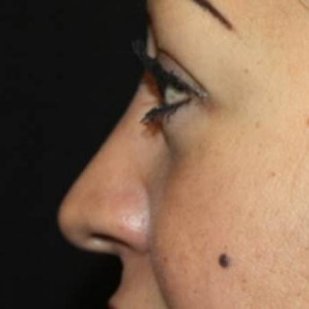 After image 3 Case #85136 - Rhinoplasty - 43 year old female