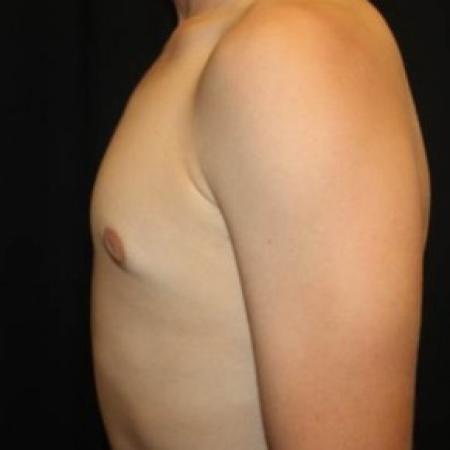 After image 3 Case #84536 - Gynecomastia - 17 year old male