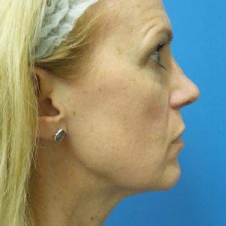 After image 3 Case #87096 - 49 year old  -  Rhinoplasty/Septoplasty/Turbinectomy  -  3 months post-op
