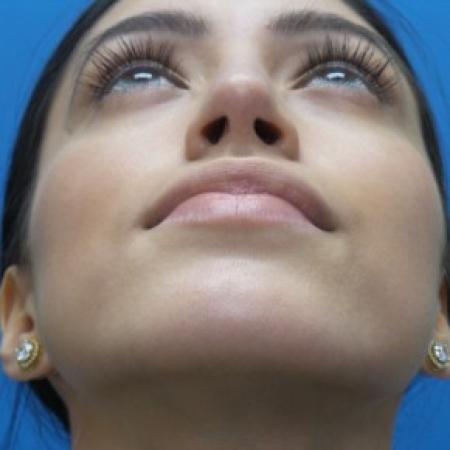 After image 4 Case #87301 - 23-year old - Open Rhinoplasty - 3 months post-op