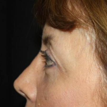 After image 3 Case #84711 - Blepharoplasty - 59 year old female.