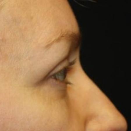 After image 3 Case #85046 - Blepharoplasty - Upper Lids Only - 46 year old female